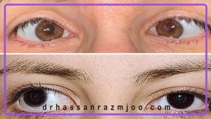 جراحی استرابیسم