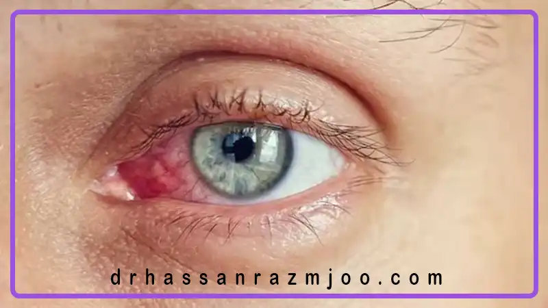 تفاوت التهاب چشم آلرژیک و عفونی