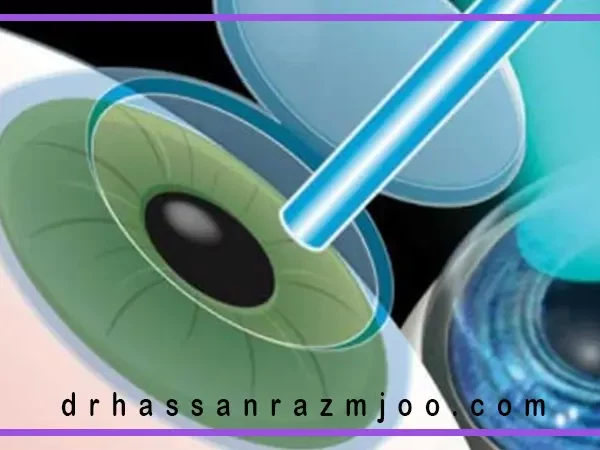 تفاوت عمل لیزیک و لازک چیست؟