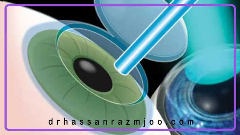 تفاوت عمل لیزیک و لازک چیست؟