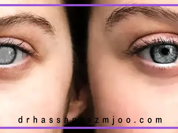 روند بهبودی بعد از جراحی چشم