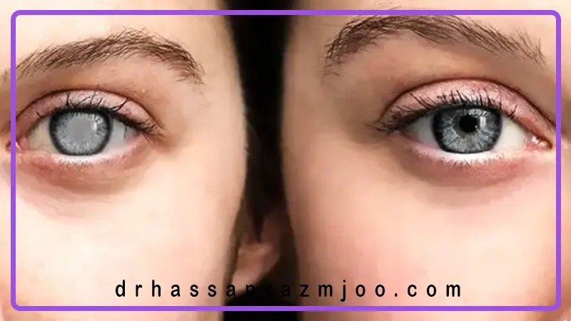 روند بهبودی بعد از جراحی چشم