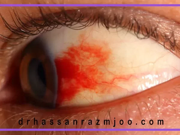 رتینوپاتی دیابتی