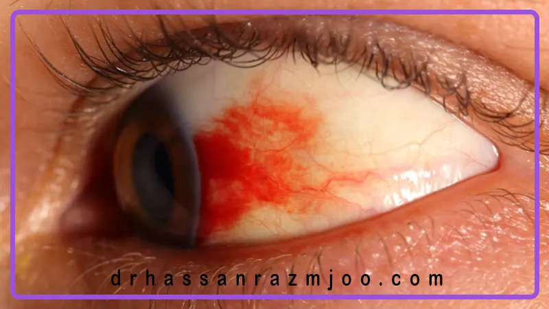 رتینوپاتی دیابتی