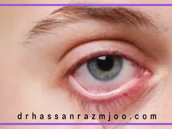 ۵ باور غلط درباره سلامت چشم