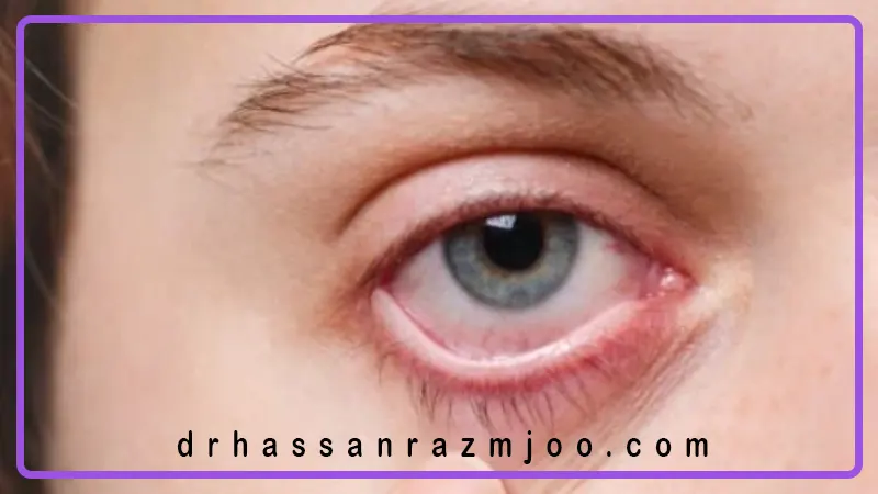 ۵ باور غلط درباره سلامت چشم