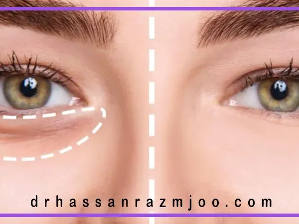 علت پف زیر چشم چیست؟
