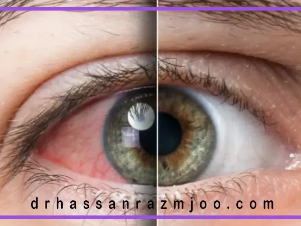 بیماری ماکولا چیست