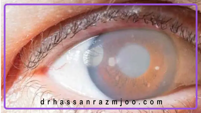 رژیم غذایی ضد آب سیاه