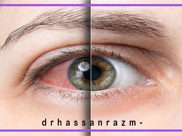 علائم اورژانسی چشمی