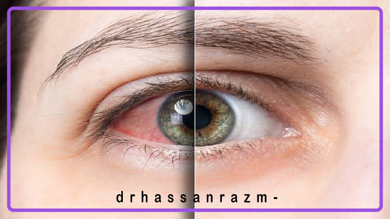 علائم اورژانسی چشمی