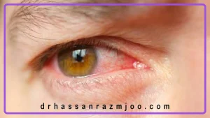 قرص یا قطره برای عفونت چشم