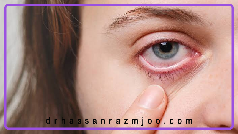 قرص یا قطره برای عفونت چشم